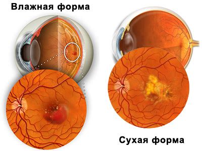 Причины сухой макулодистрофии