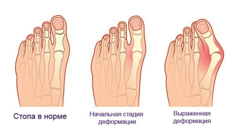 Проблема с пальцем ноги