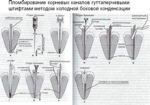 Прогнозы развития использования горячей гуттаперчи в стоматологии