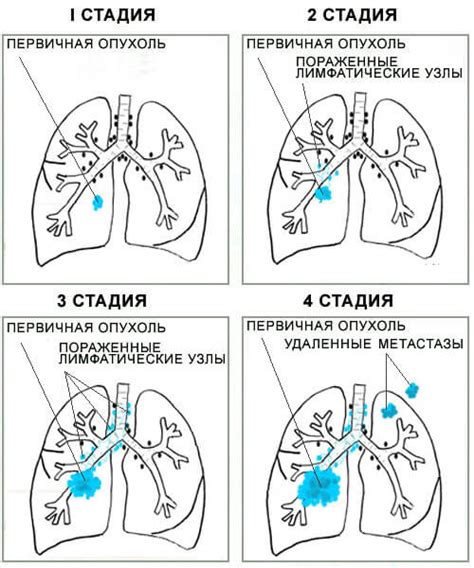 Прогноз для больных с метастазами в легких