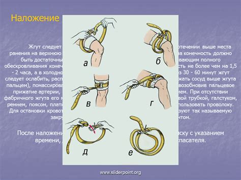 Продолжительность ношения жгута на конечности