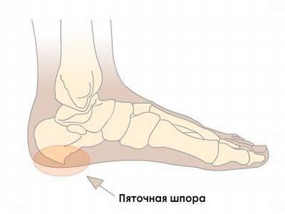 Простые и доступные способы удаления шпор на подошве