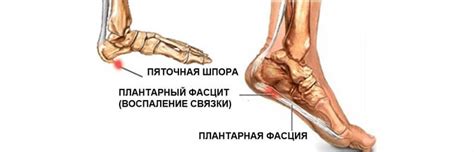 Профессиональные причины наступления на пятки