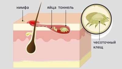 Профилактика и защита от чесоточного клеща