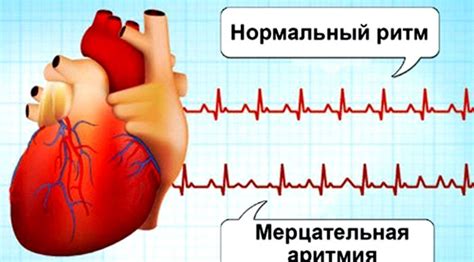 Профилактические меры для поддержания нормального ритма сердца