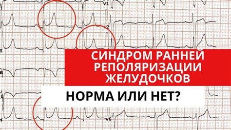 Процесс реполяризации желудочков на ЭКГ
