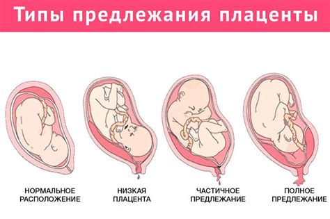 Процесс формирования плаценты 2 степени