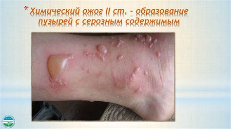 Развитие химических ожогов