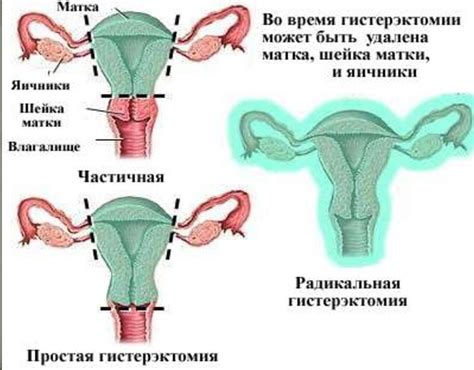 Различные патологии матки и яичников