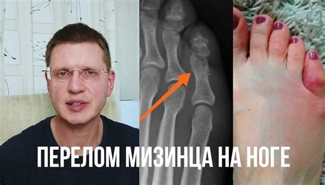 Раскрытие мизинца