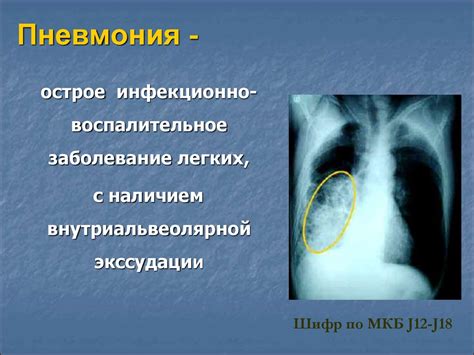 Рентгеновский метод диагностики пневмонии у детей