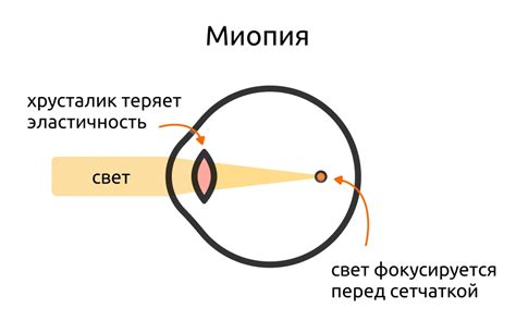 Рефракция глаза: объяснение и механизмы нарушения