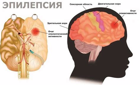 Родовая травма и ее влияние на развитие эпилепсии