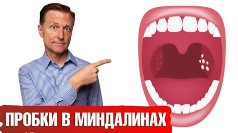 Роль плакков при возникновении темных отложений на миндалинах