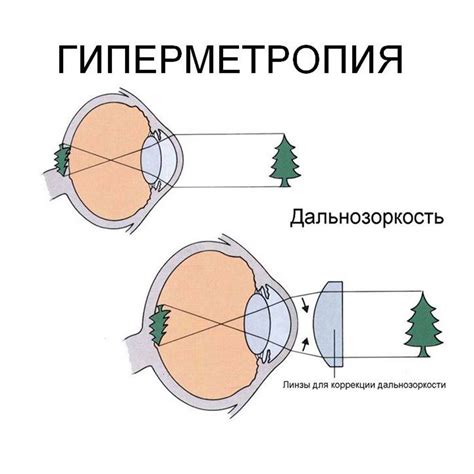 Самостоятельное определение дальнозоркости