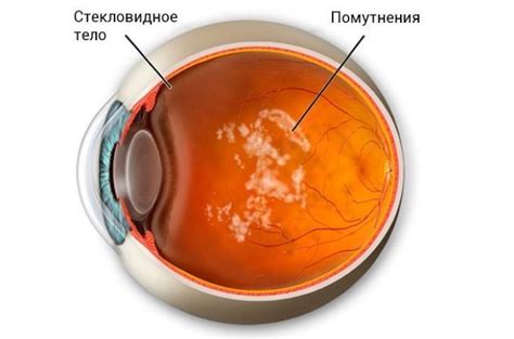 Серьезные заболевания, связанные с возникновением тёмных пятен перед зрительными органами