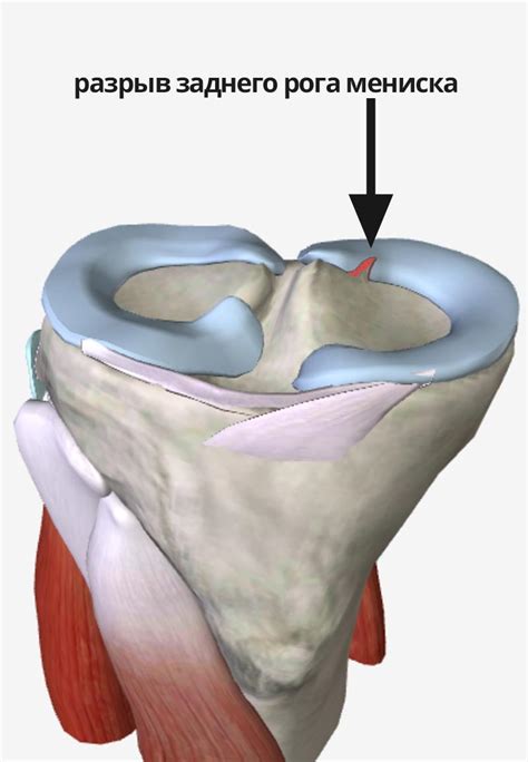 Сигналы о повреждении мениска: что следует обратить внимание
