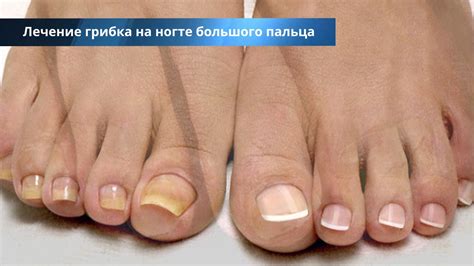 Симптомы и диагностика нарыва на большом пальце ноги