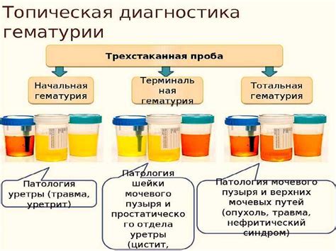 Симптомы и диагностика патологических состояний, сопровождающих изменение цвета мочи