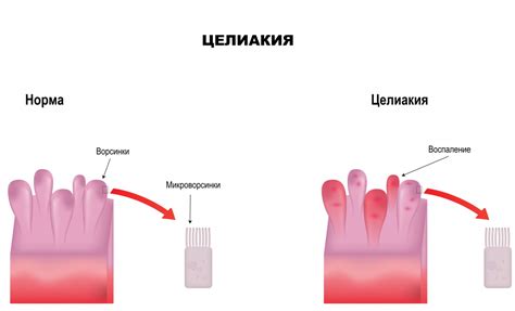 Симптомы и диагностика эпистаксиса