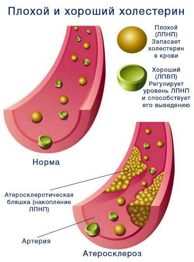 Симптомы и компликации нарушения липидного обмена