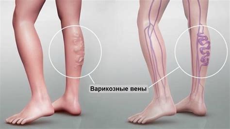 Симптомы и последствия косточек на ногах у мужчин