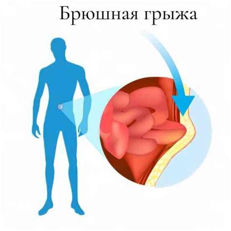 Симптомы и признаки грыжи на животе