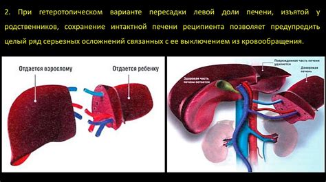 Симптомы и причины напряженного асцита