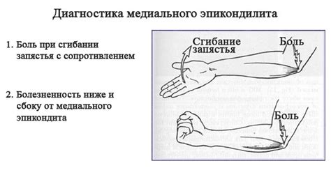 Симптомы медиального эпикондилита
