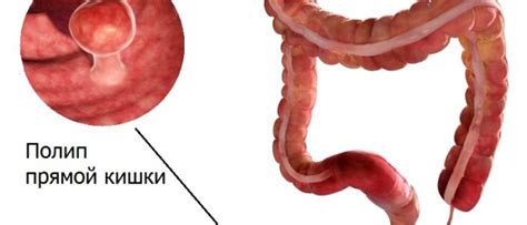 Симптомы нароста в прямой кишке