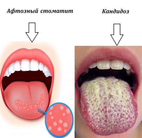 Симптомы нароста на языке