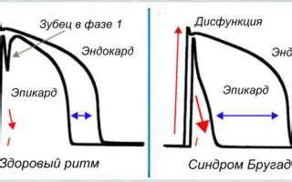 Симптомы нарушения фазы реполяризации