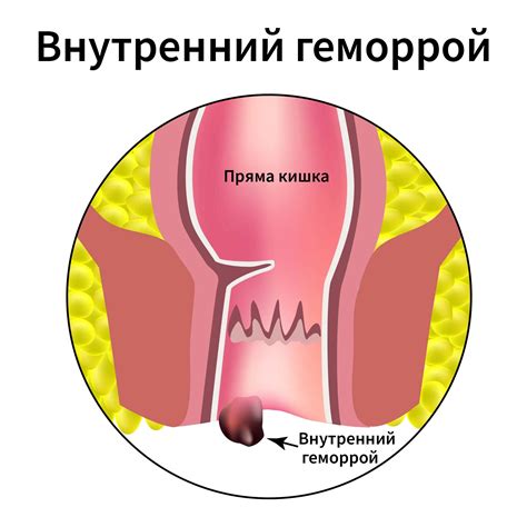 Симптомы тромбированного наружного геморроя