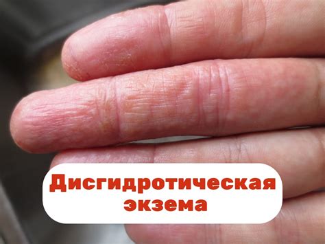 Симптомы шишек на пальцах и их последствия