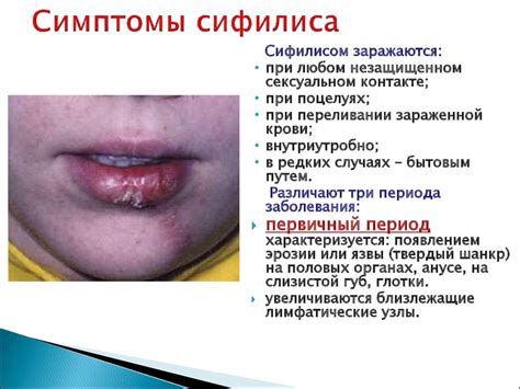 Сифилис: основные факты