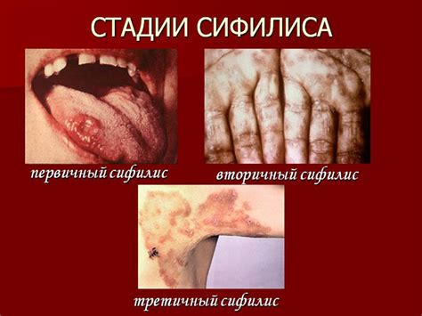 Сифилис: причины и симптомы