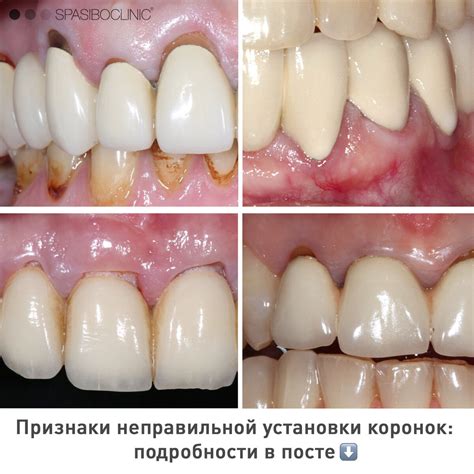 Следствия неправильной приклеивания коронки