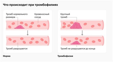 Снижение риска образования тромбов