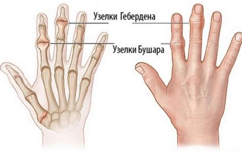 Советы специалистов по удалению узелков Гебердена