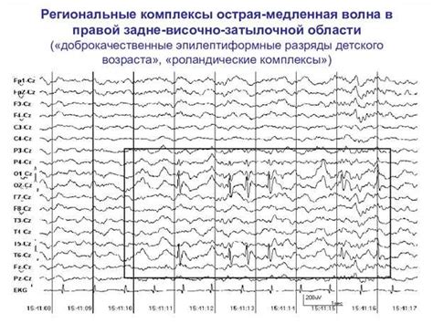 Современные подходы к диагностике эпилепсии: роль электроэнцефалографии