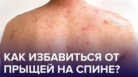 Способы снижения отека после выскальзывания прыща на коже: советы и рекомендации