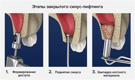 Сроки восстановления после синус лифтинга