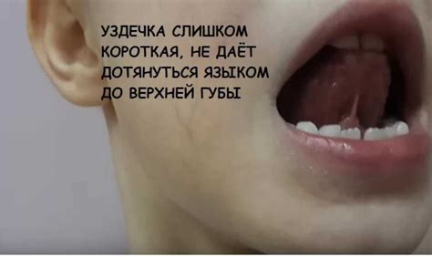Сроки восстановления у межгубной уздечки