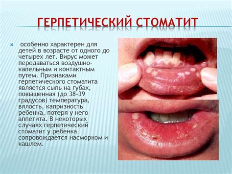 Типы стоматита