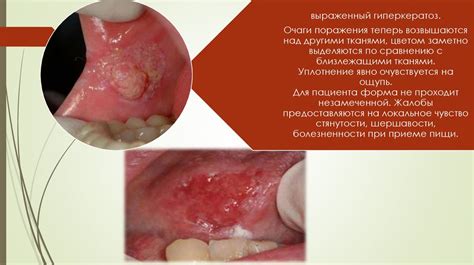 Травмы слизистой рта