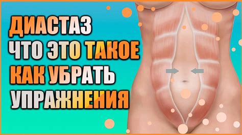 Тренировка для диастазом