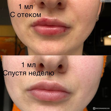 Увеличение срока заживления