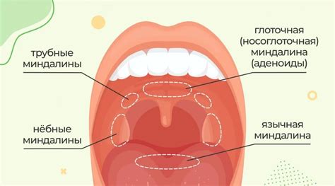 Увеличенные миндалины у взрослого: причины, симптомы и лечение