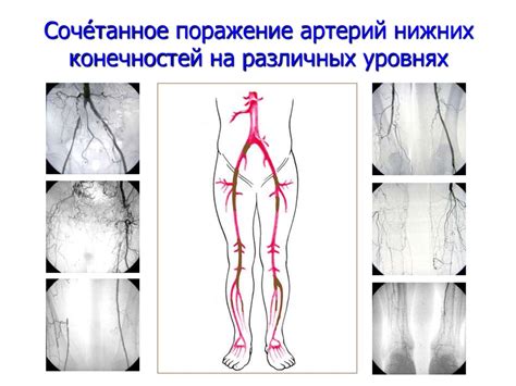 Укрепление кровоснабжения в нижних конечностях