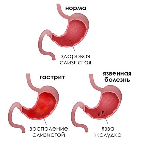 Фаст-фуд и гастрит: воздействие и противопоказания